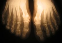 Osteoporóza: Příznaky, léčba a prevence